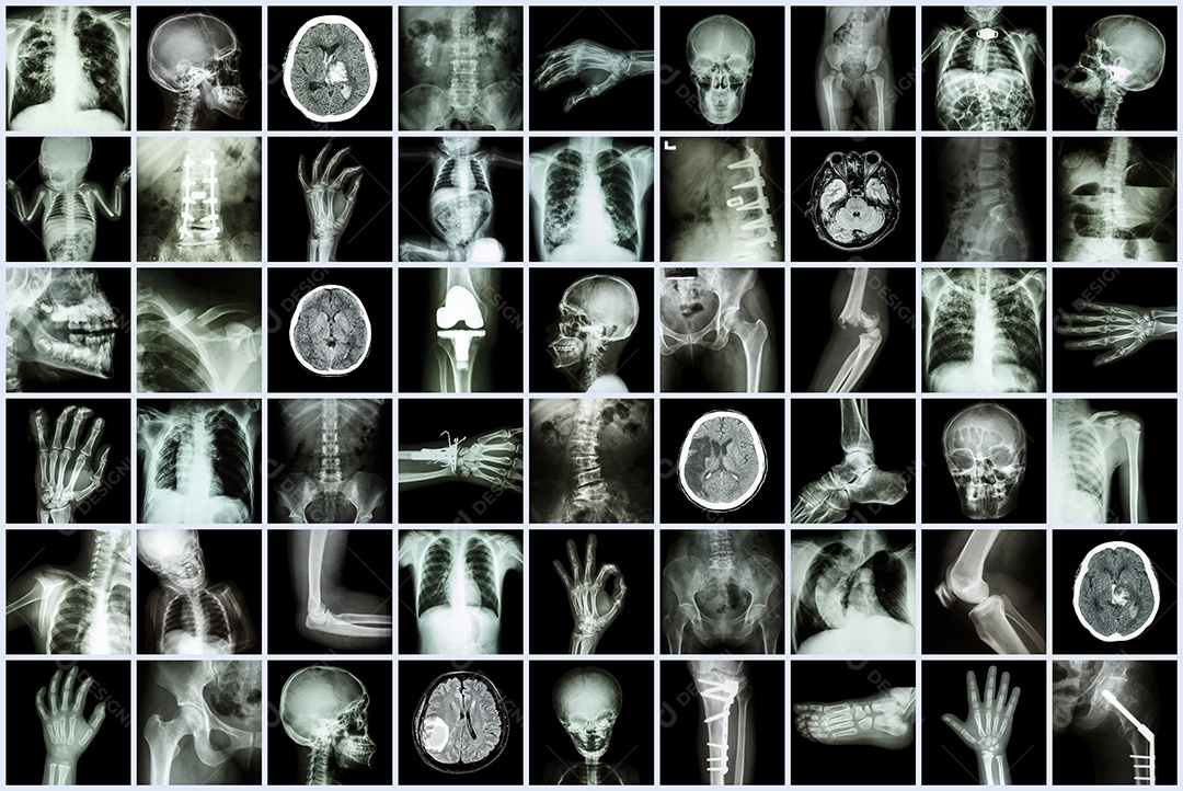 Pulmão saudável raio x corpo inteiro