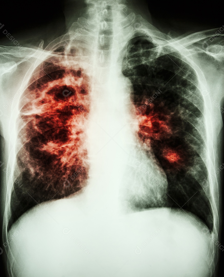 Tuberculose pulmonar mostra infiltração intersticial em ambos os pulmões devido à infecção