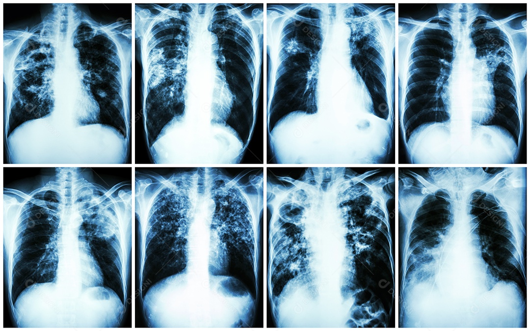 Coleção de tuberculose pulmonar