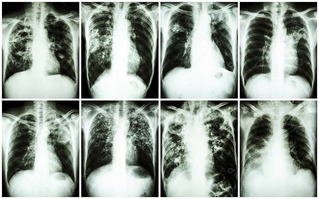 Coleção de tuberculose pulmonar