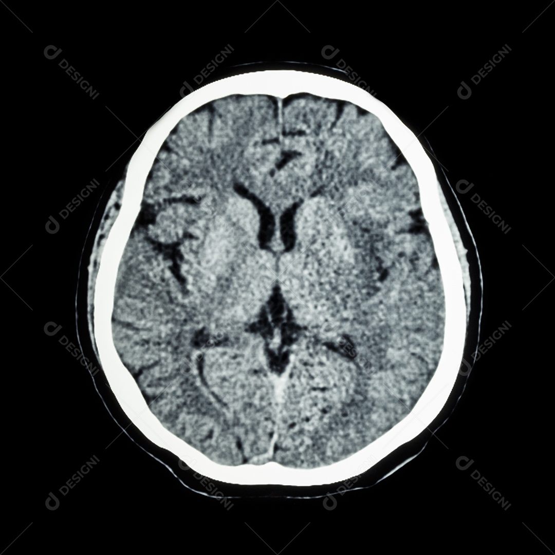 Tomografia computadorizada do cérebro mostra a linha de seção no crânio