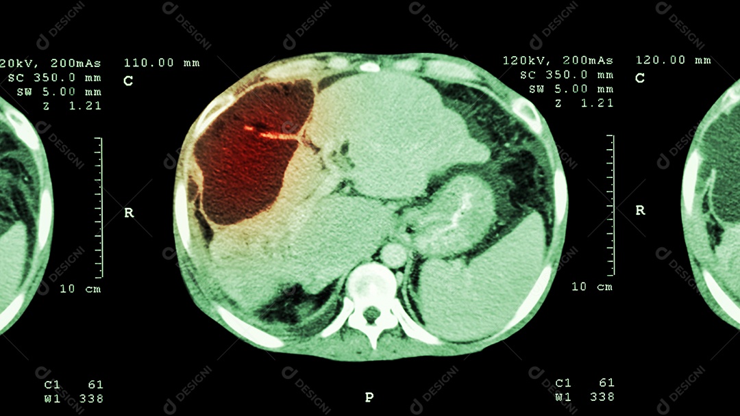 Tomografia computadorizada do cérebro normal sistema cerebrovascular