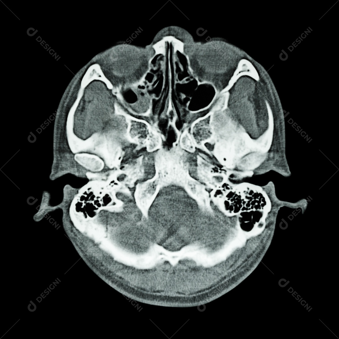 Lesão cerebral acidente vascular cerebral tomografia computadorizada