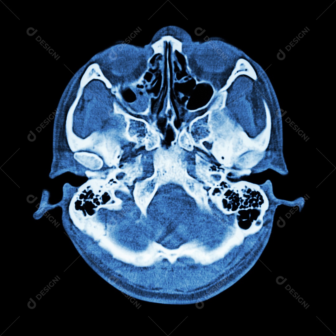 Lesão cerebral acidente vascular cerebral tomografia computadorizada