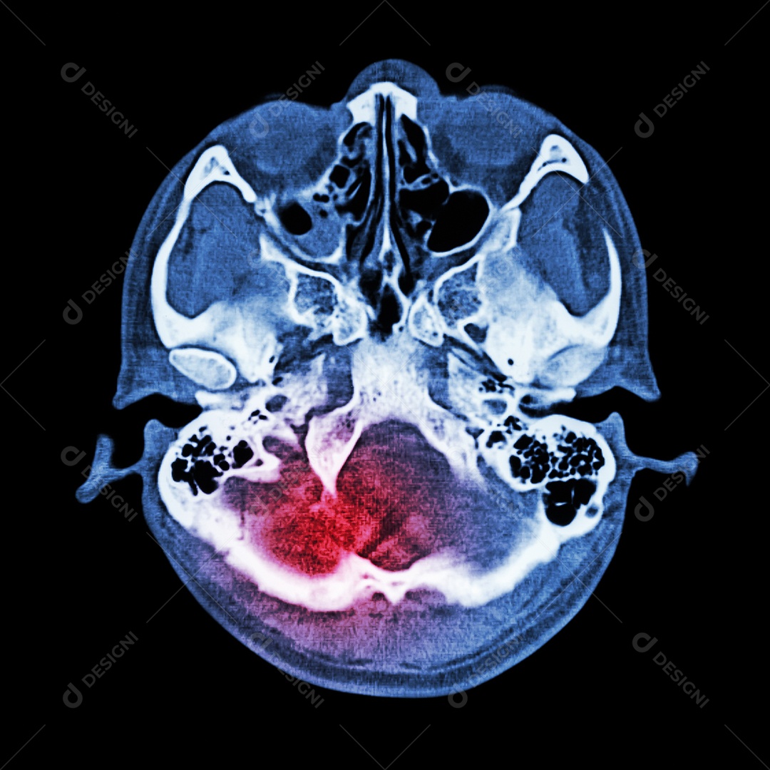 Lesão cerebral acidente vascular cerebral tomografia computadorizada
