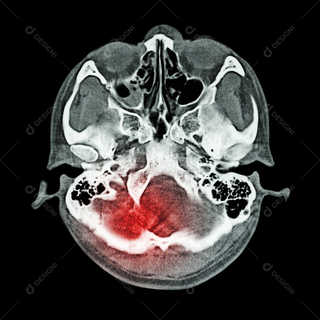 Lesão cerebral acidente vascular cerebral tomografia computadorizada