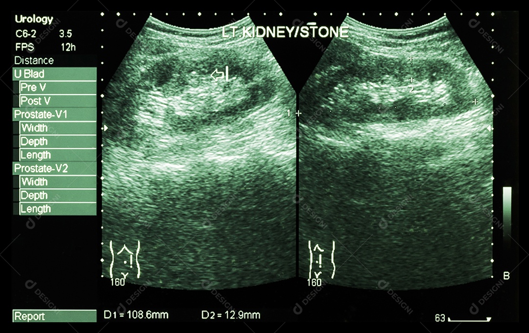 Tuberculose pulmonar mostra infiltração intersticial em ambos os pulmões devido à infecção