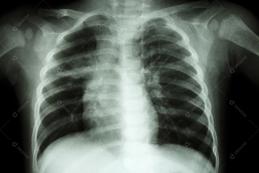 Tuberculose pulmonar mostra infiltração intersticial em ambos os pulmões devido à infecção