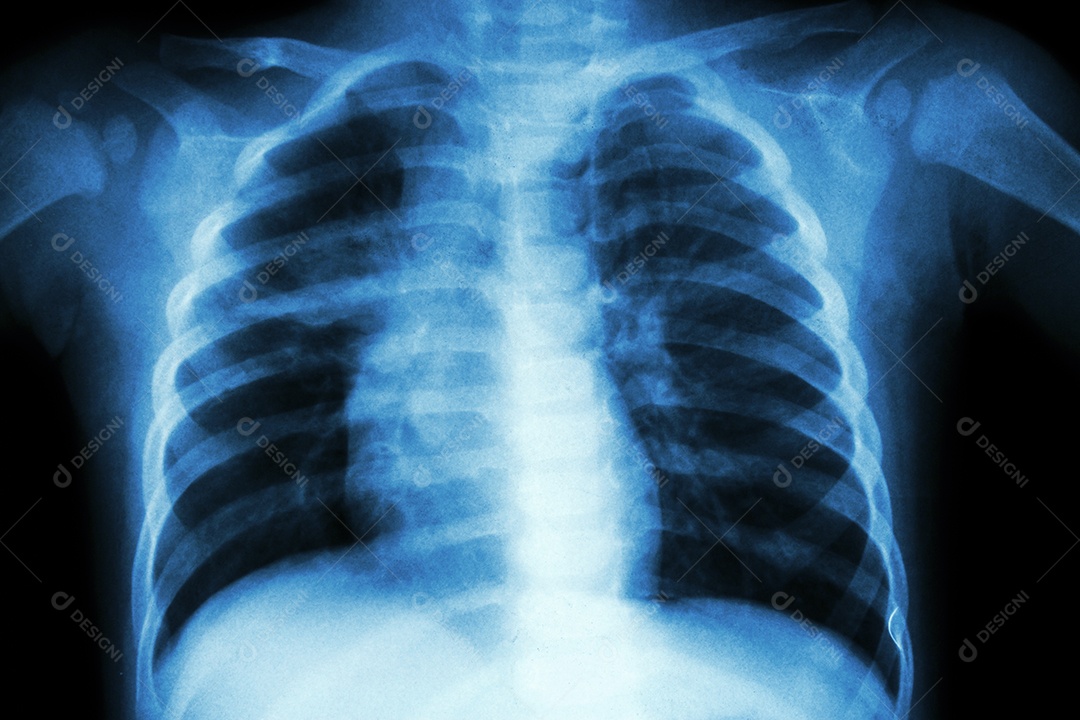 Pneumonia com insuficiência respiratória radiografia de tórax com tubo endotraqueal