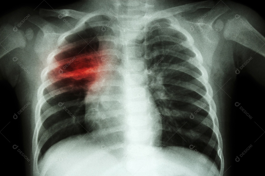 Pneumonia com insuficiência respiratória radiografia de tórax com tubo endotraqueal
