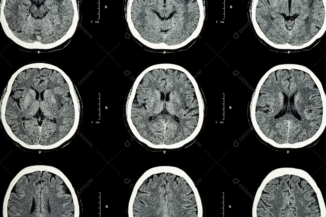 Tomografia computadorizada do cérebro mostra acidente vascular cerebral isquêmico