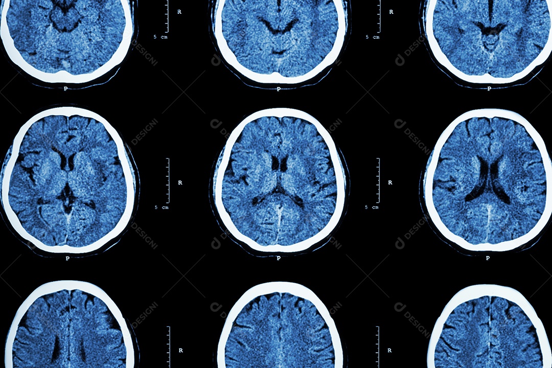 Tomografia computadorizada acidente vascular cerebral hemorrágico