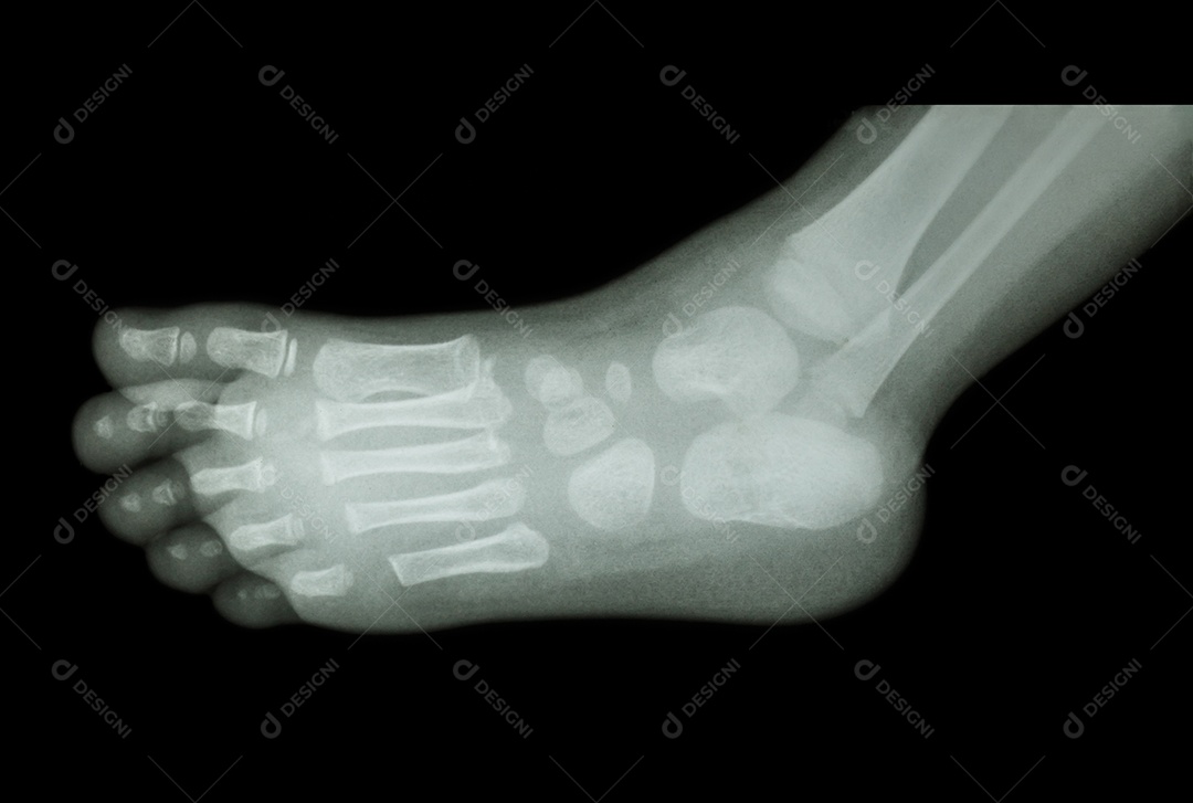 Filme raio x de ambos os pés