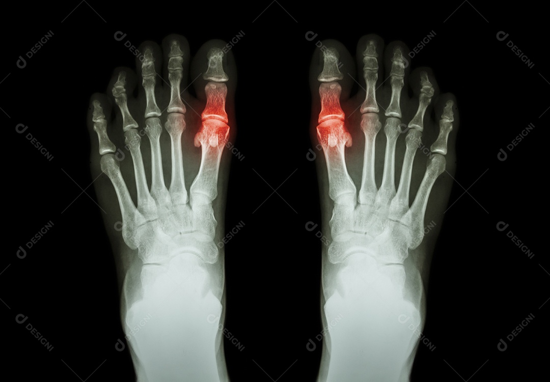 Filme de raio x de ambos os pés vista frontal