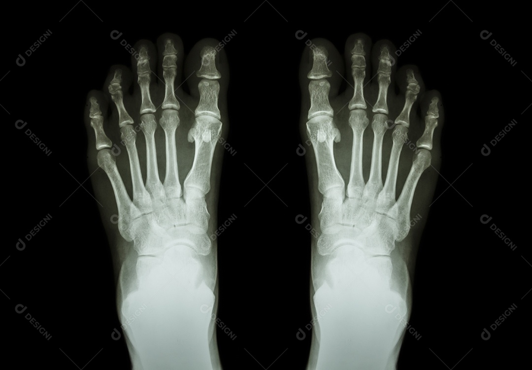 Filme de raio x de ambos os pés vista frontal