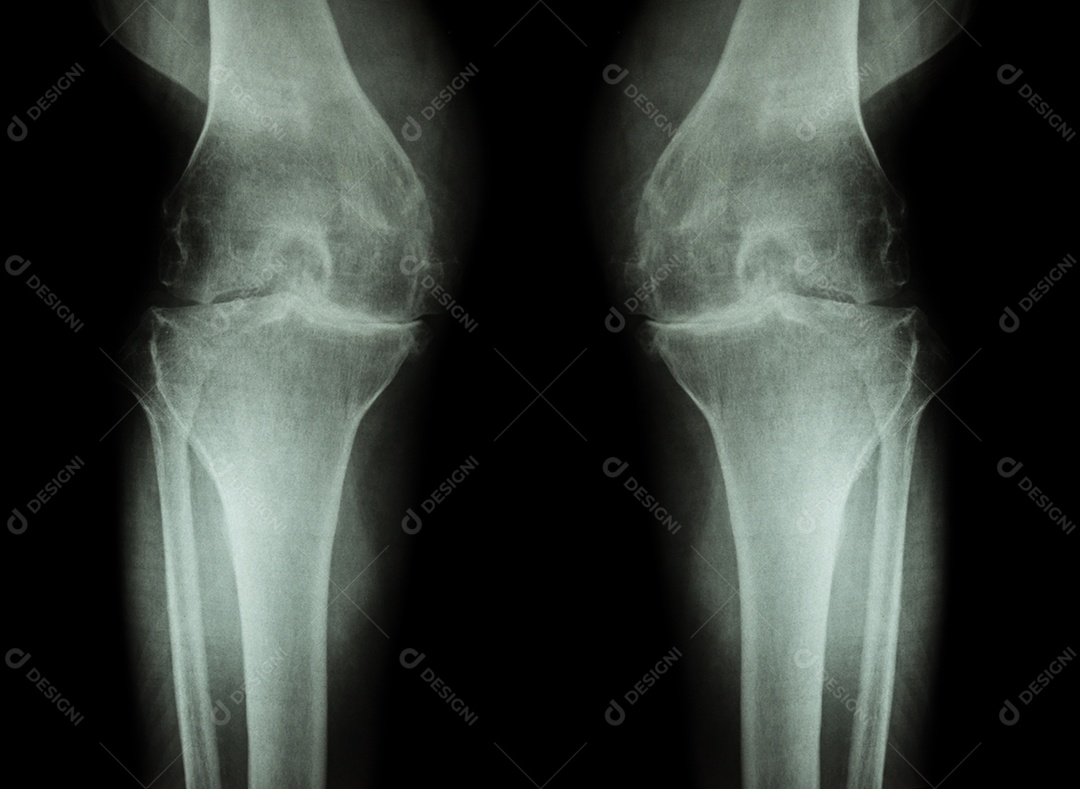 Osteoartrite do joelho radiografia de ambos os joelhos com artrite
