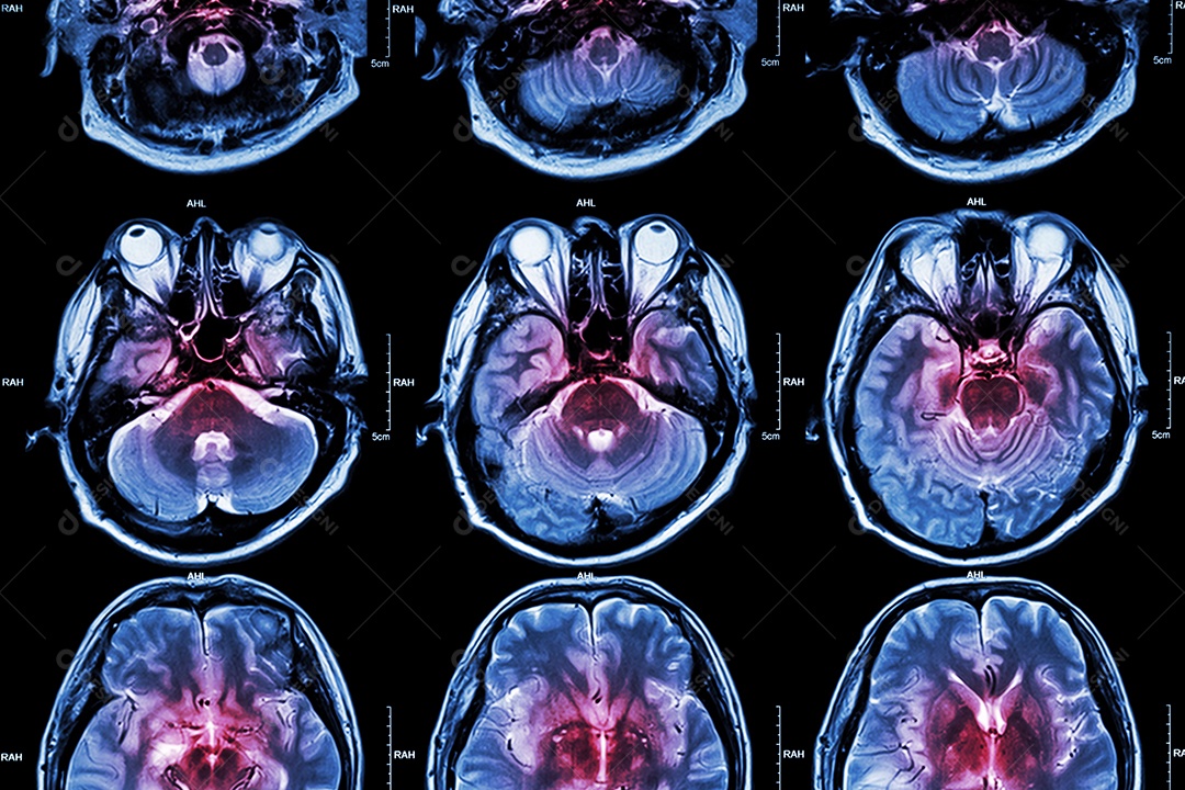 Ressonância magnética do cérebro