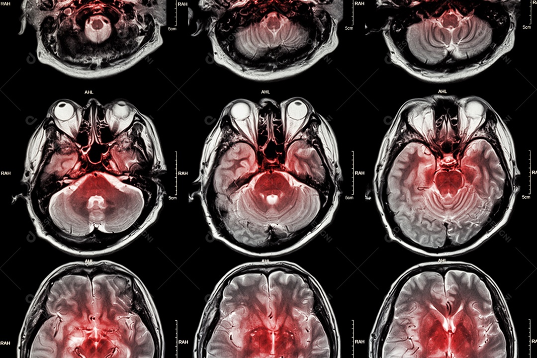 Ressonância magnética do cérebro mostra tumor cerebral no lobo parietal