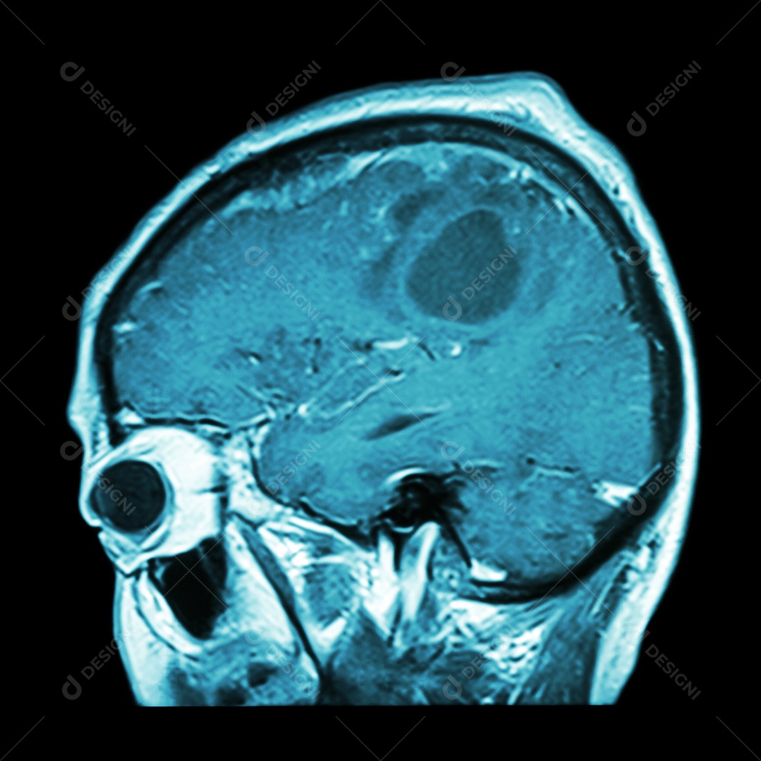 Ressonância magnética do cérebro com tumor cerebral