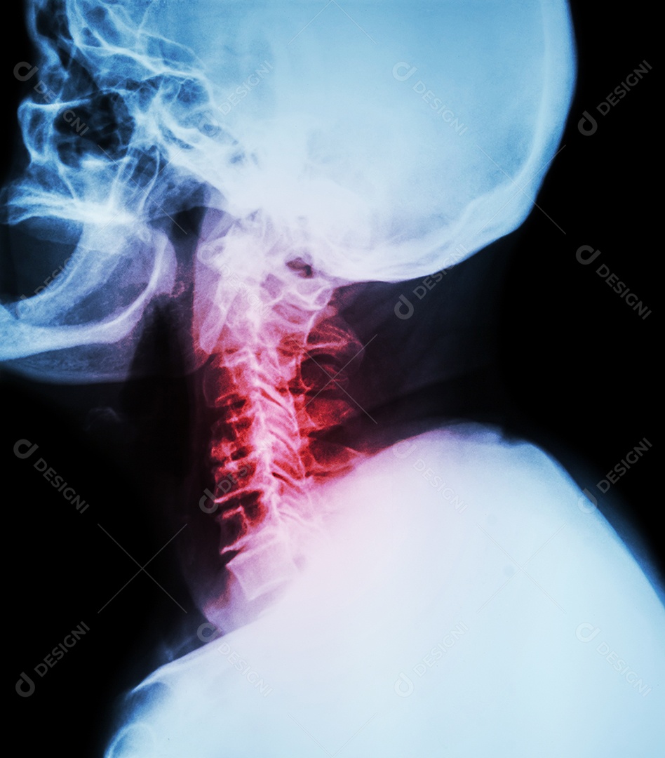 Radiografia de filme da coluna cervical espondilose