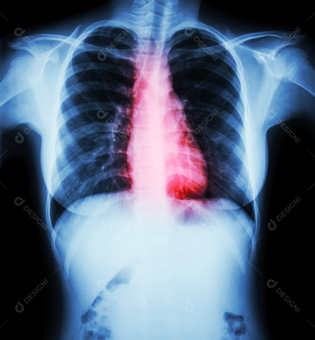 Filme de raio x de tórax de mulher com doença cardíaca