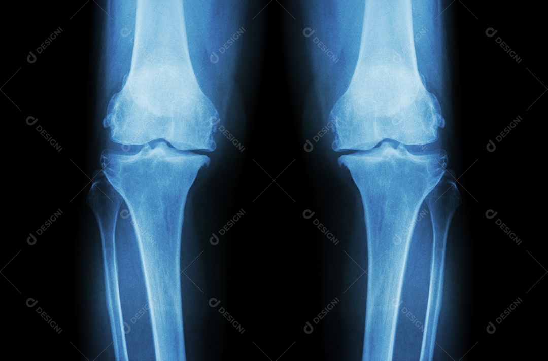 Joelho normal e joelho com osteoartrite