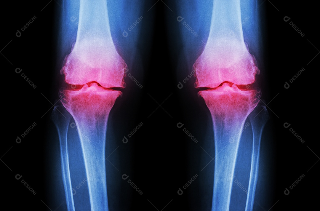 Osteoartrite do joelho radiografia de ambos os joelhos mostra perda de cartilagem articular