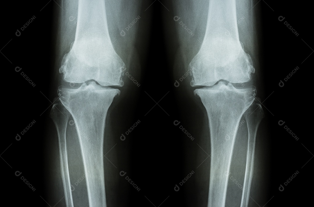 Osteoartrite do joelho radiografia de ambos os joelhos mostra perda de cartilagem articular