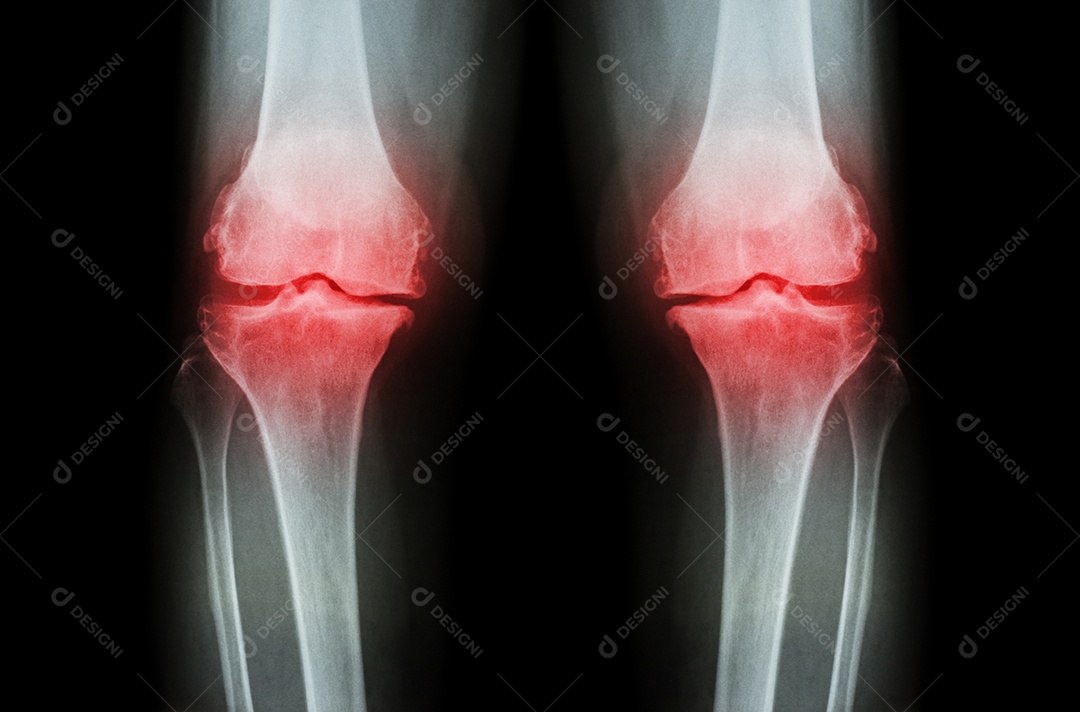 Osteoartrite do joelho radiografia de ambos os joelhos mostra perda de cartilagem articular