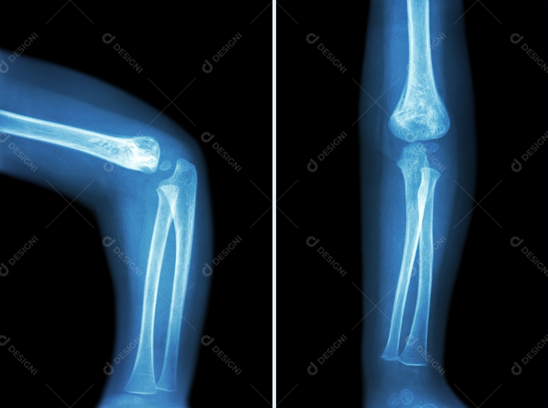 Artrite reumatóide raio x do cotovelo de uma criança