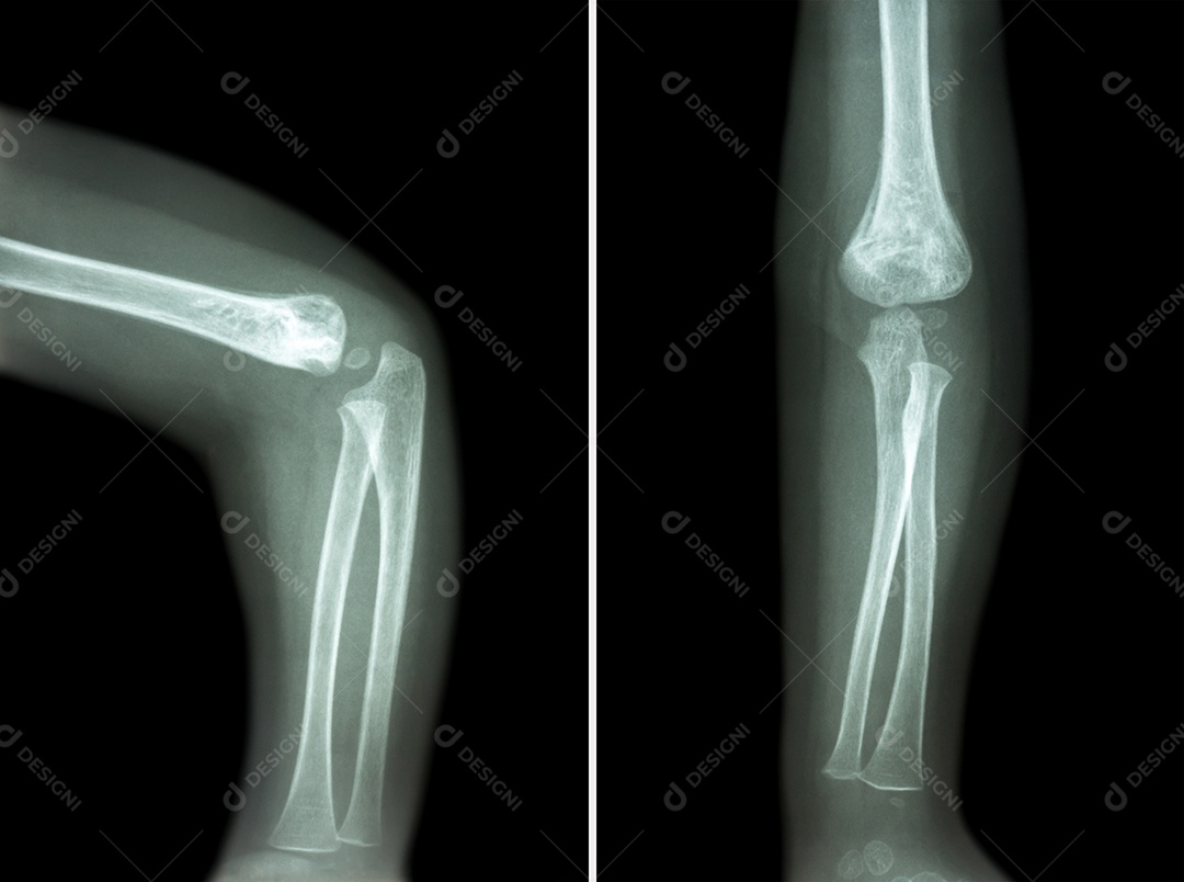 Artrite reumatóide raio x do cotovelo de uma criança