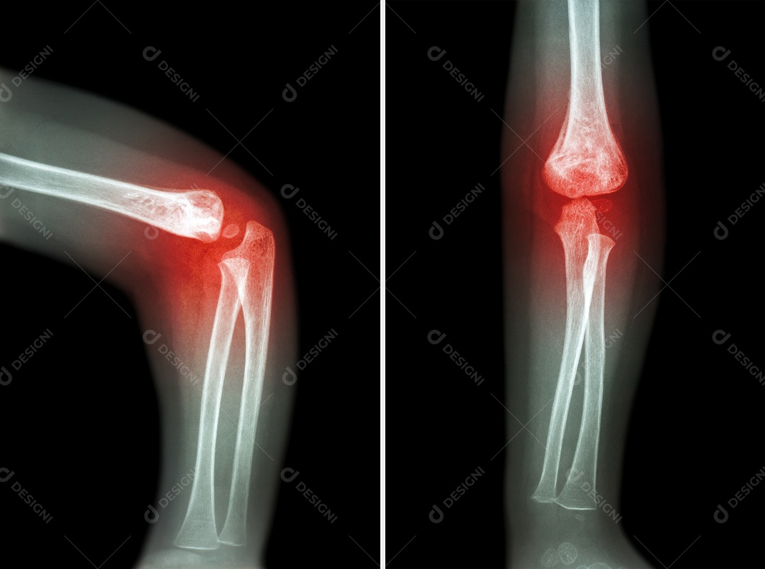 Artrite reumatóide raio x do cotovelo de uma criança