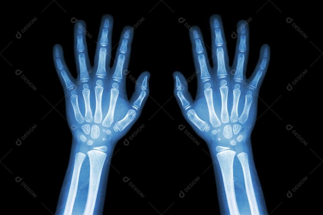 Artrite reumatóide gotosa raio x de ambas as mãos de uma criança