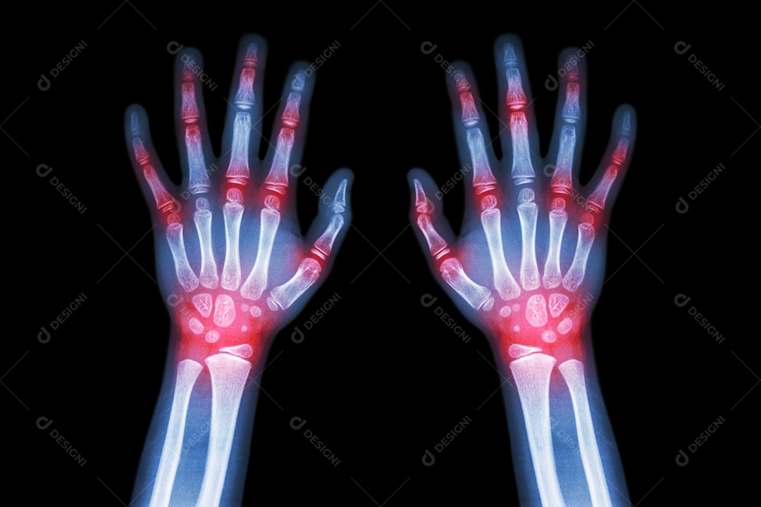 Artrite reumatóide gotosa raio x de ambas as mãos de uma criança