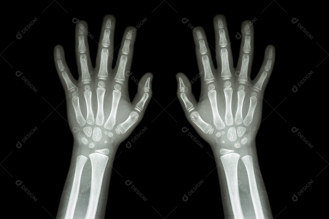 Artrite reumatóide gotosa raio x de ambas as mãos de uma criança