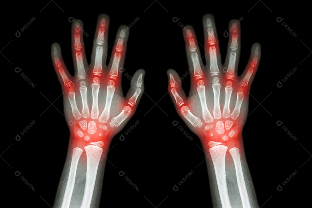 Artrite reumatóide gotosa raio x de ambas as mãos de uma criança