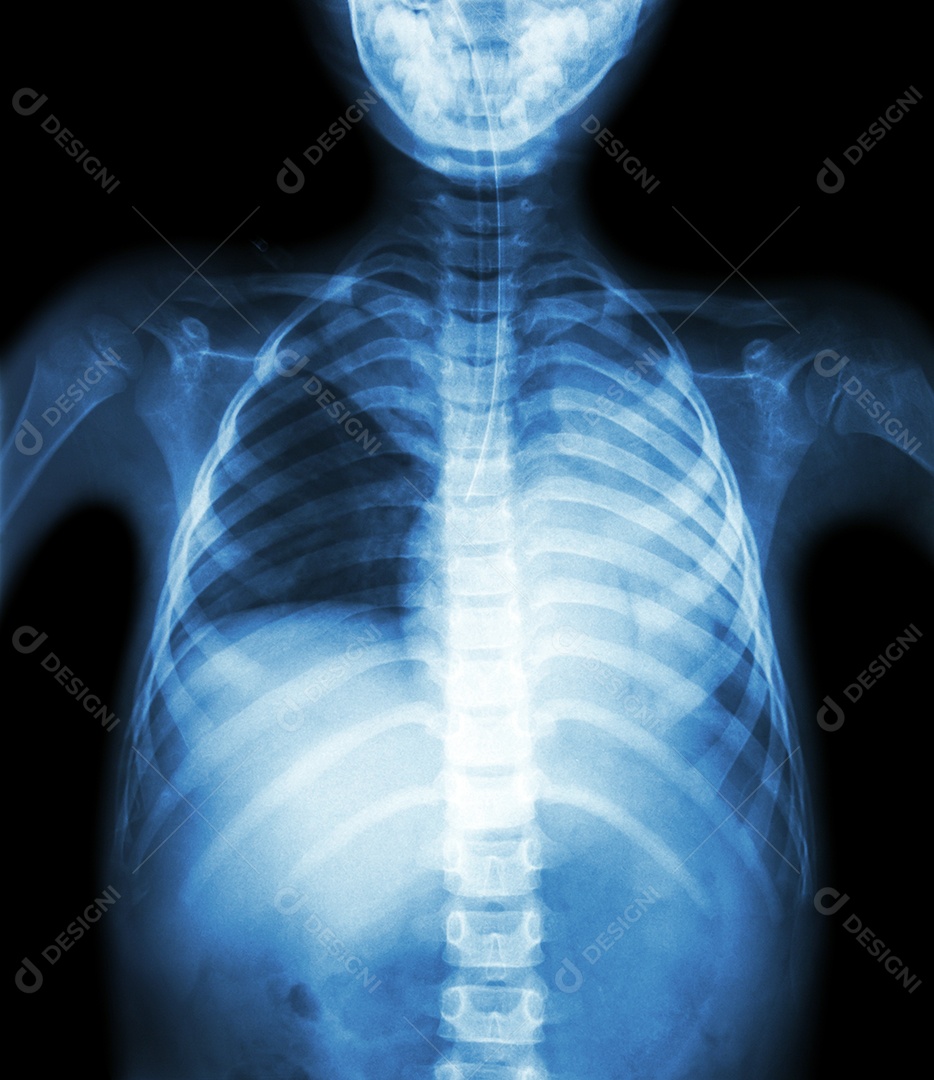 Filme de raio x do tórax PA em posição vertical