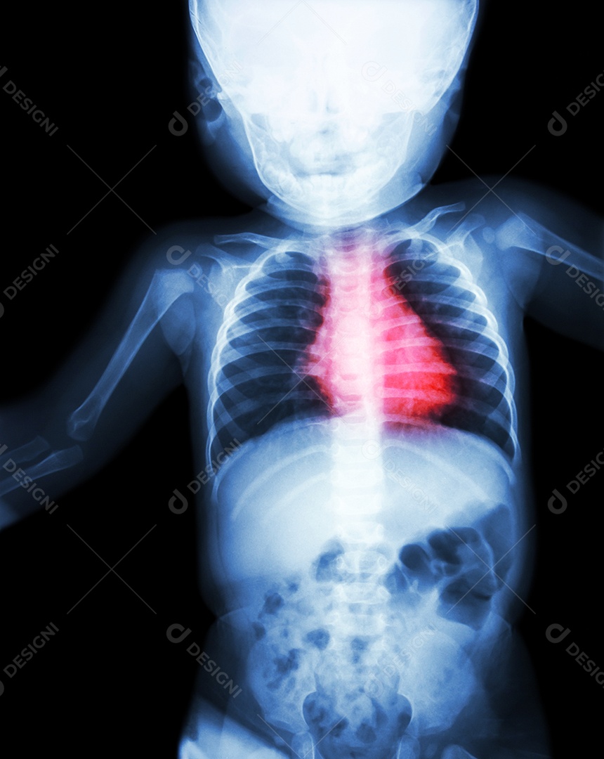 Corpo de raio x da criança e cor vermelha na área do coração