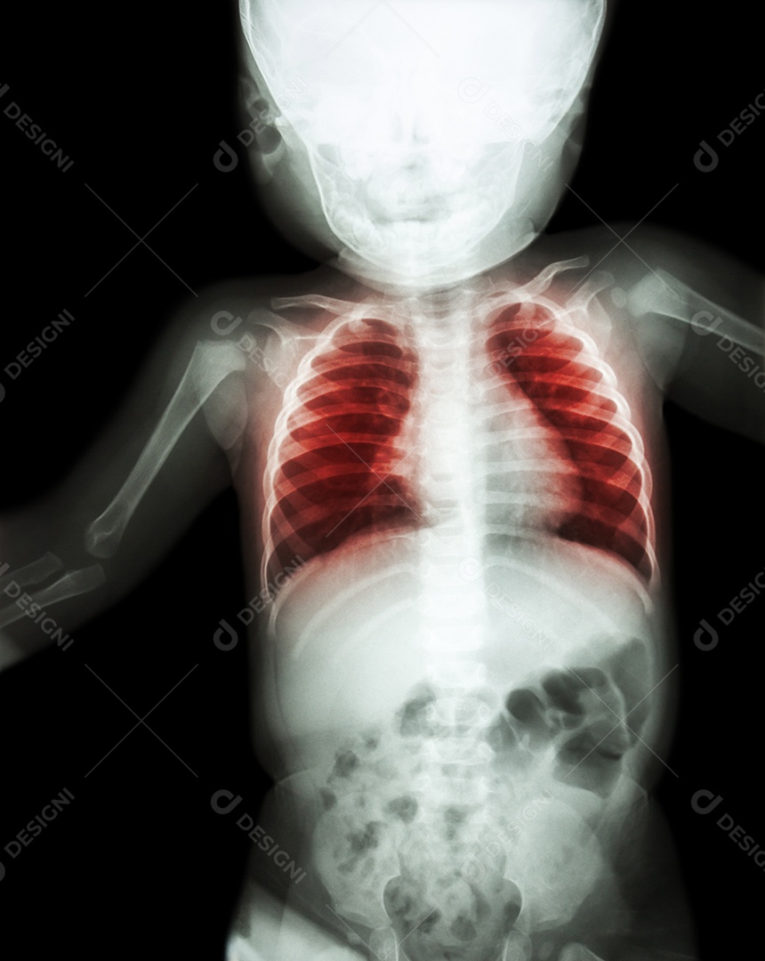 Pneumonia com insuficiência respiratória radiografia de tórax com tubo endotraqueal
