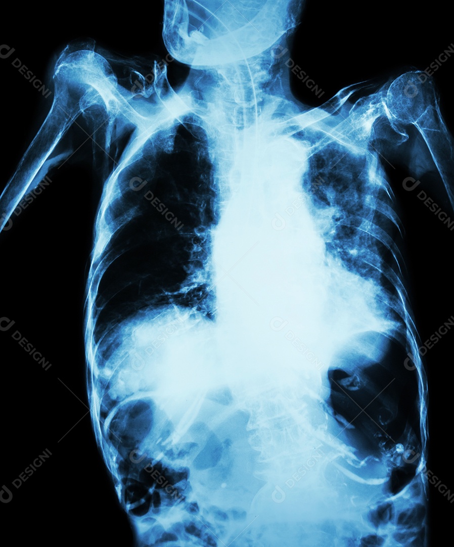 Tuberculose pulmonar com insuficiência respiratória aguda