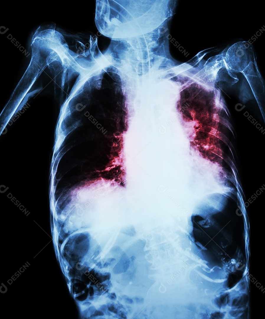 Tuberculose pulmonar com insuficiência respiratória aguda