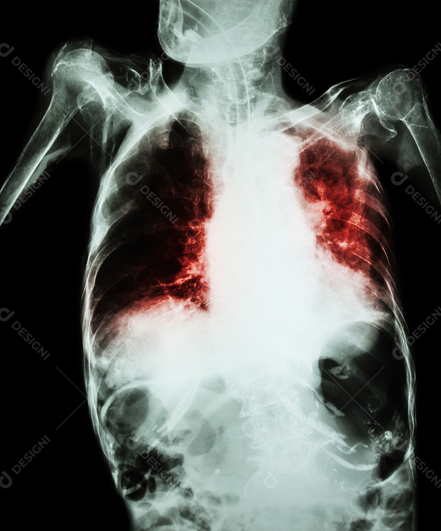 Tuberculose pulmonar com insuficiência respiratória aguda