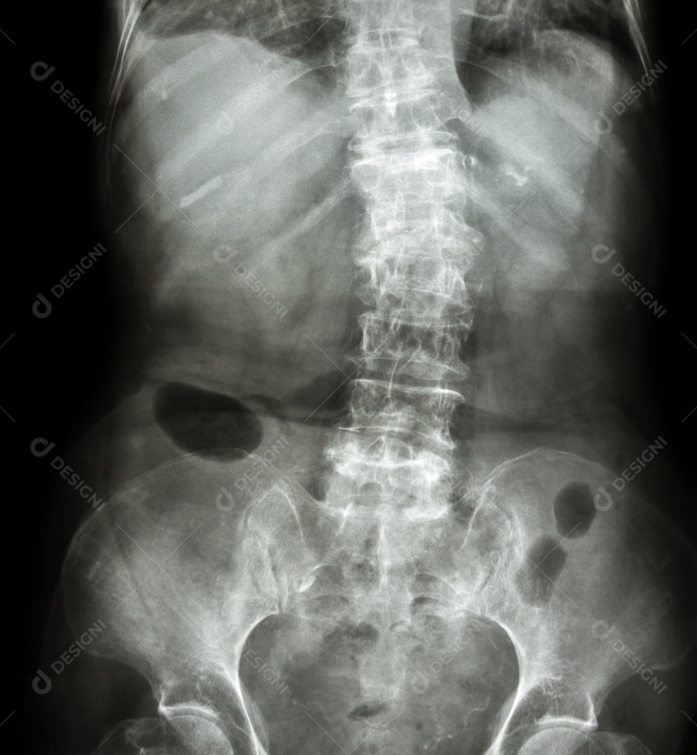 Espondilose e escoliose raio x da coluna lombar e sacro mostra coluna torta
