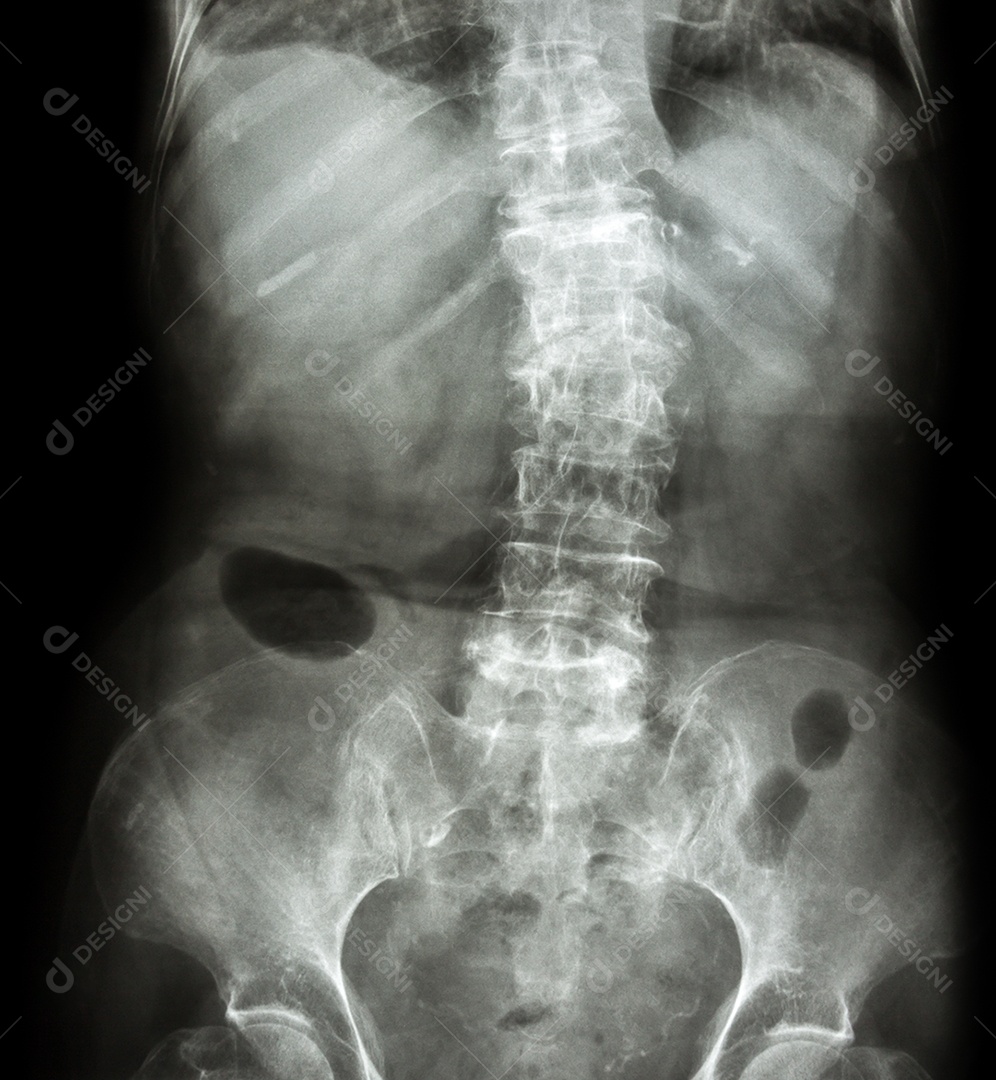 Espondilose e escoliose raio x da coluna lombar e sacro mostra coluna torta