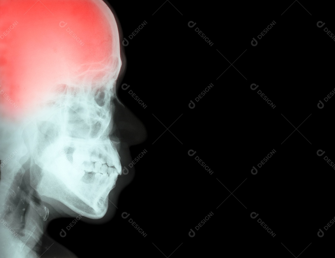 Filme de raio x lateral do crânio com acidente vascular cerebral