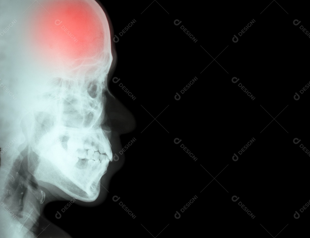Filme de raio x lateral do crânio com acidente vascular cerebral