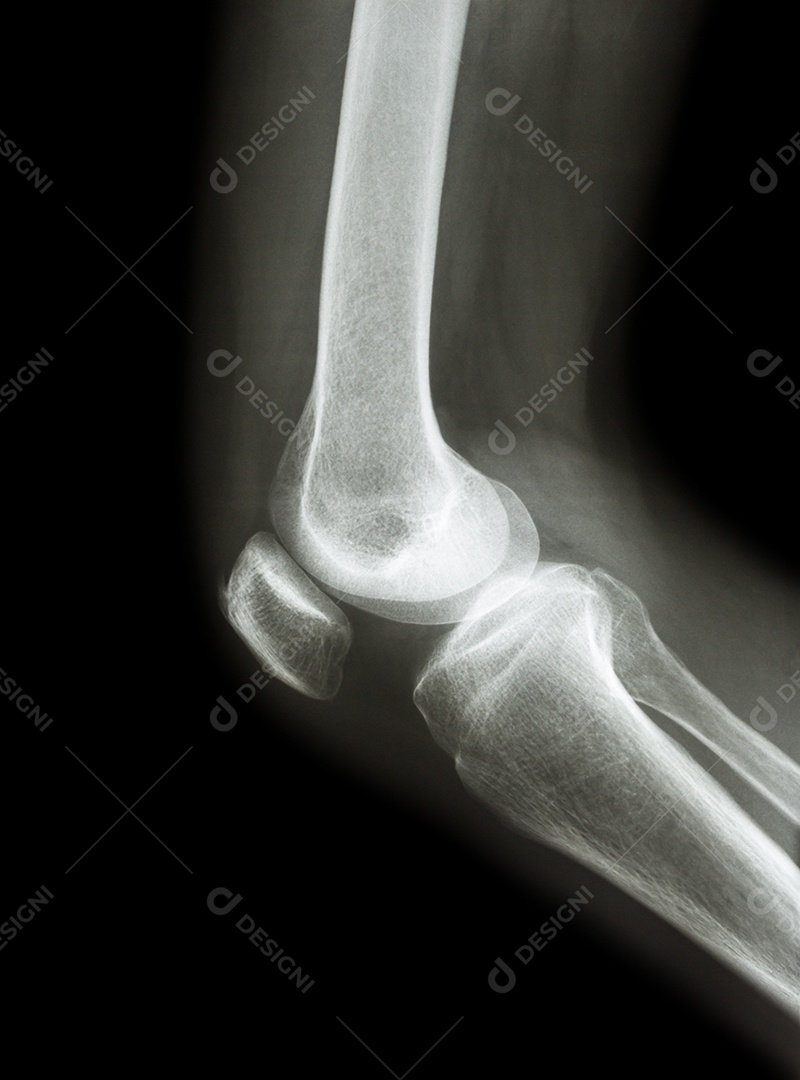 Filme raio x do joelho do paciente com osteoartrite e articulação artificial