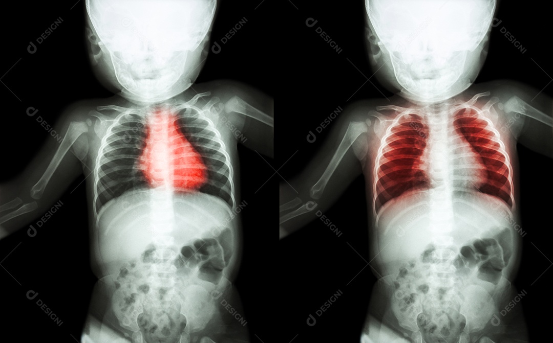 Tuberculose pulmonar raio x completo de uma criança