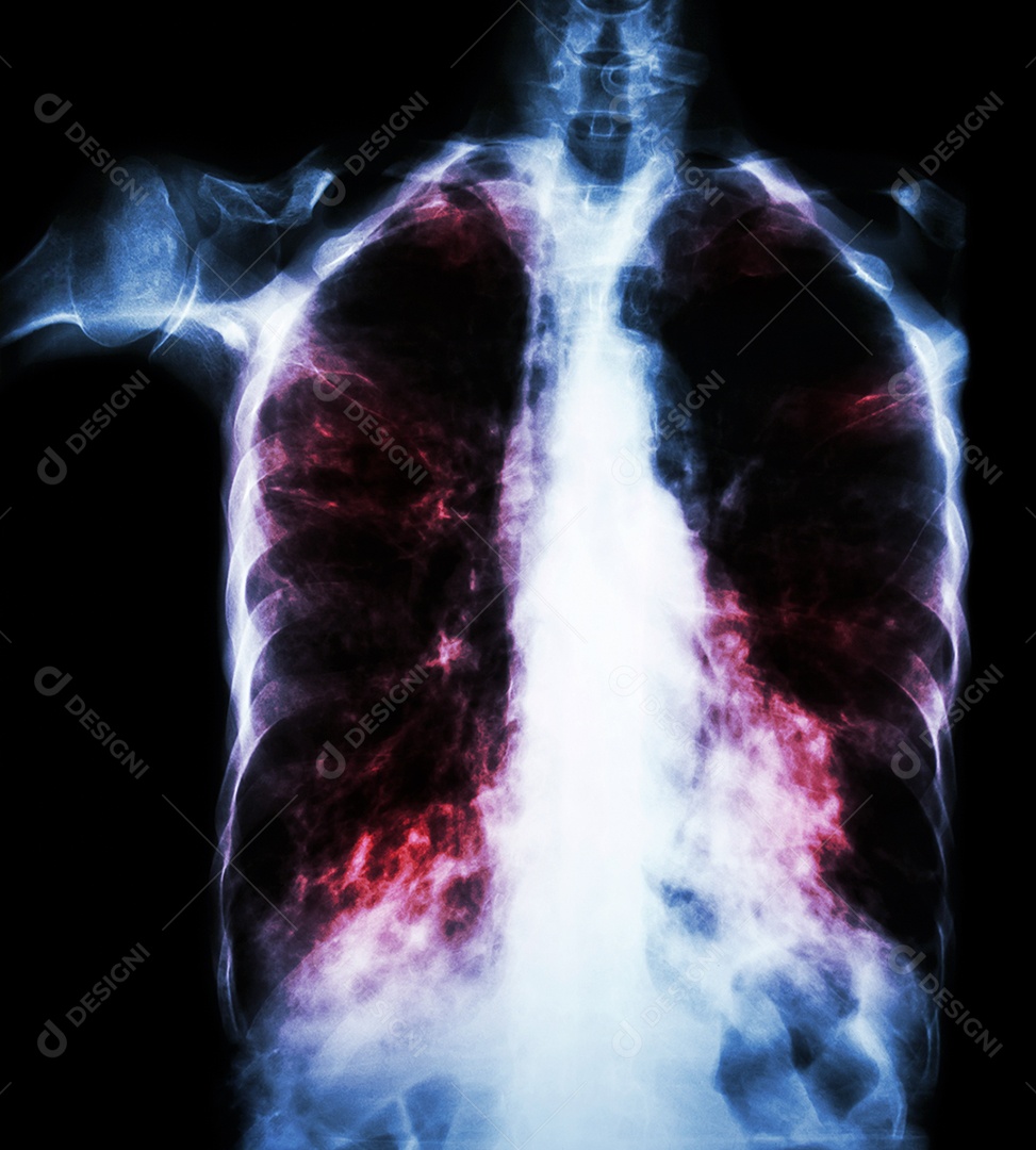 Tuberculose pulmonar radiografia de tórax