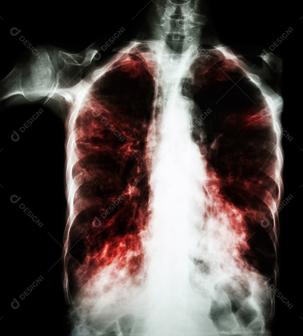 Tuberculose pulmonar radiografia de tórax
